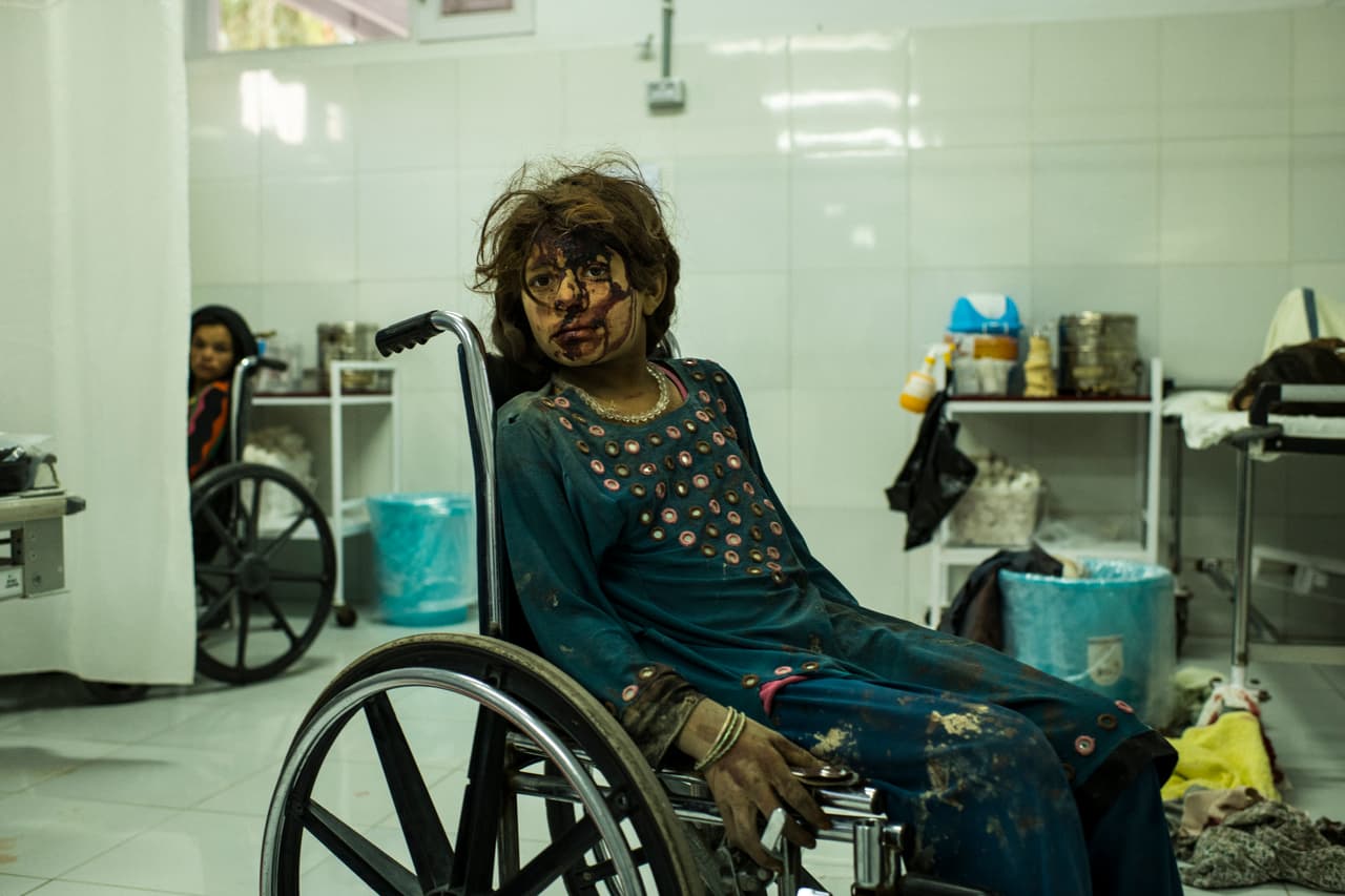 A girl with a bloodied face from a head wound sits in a wheelchair in a hospital ward